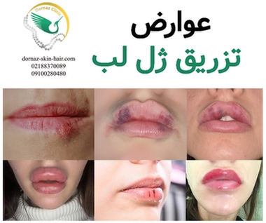 عوارض تزریق ژل لب