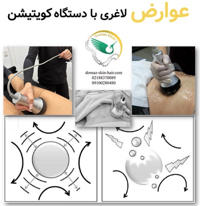 عوارض لاغری با دستگاه کویتیشن
