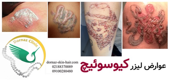 عوارض لیزر کیوسوئیچ