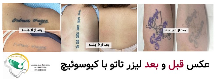 عکس قبل و بعد لیزر تاتو با کیوسوئیچ