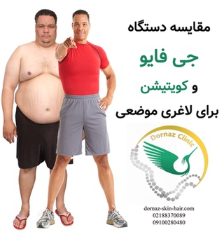 مقایسه دستگاه جی فایو و کویتیشن