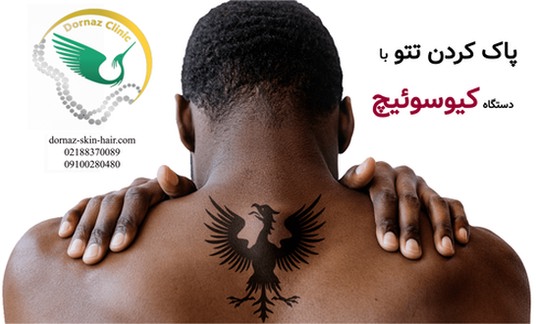 پاک کردن تتو با کیوسوئیچ