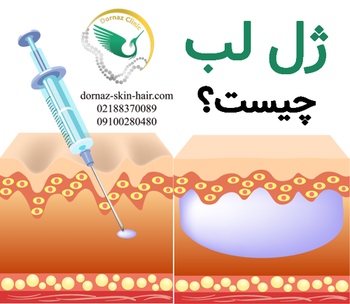 ژل و فیلر لب 