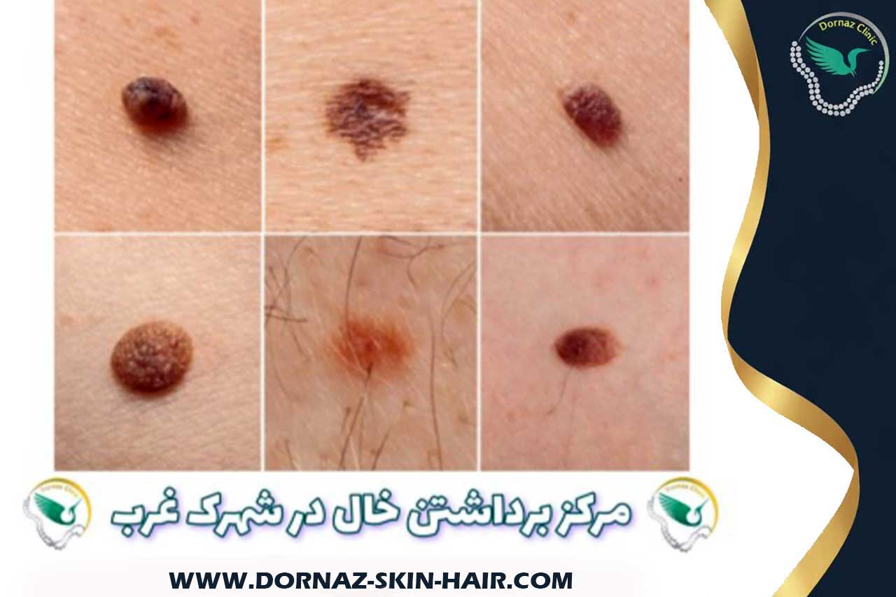 مرکز برداشتن خال