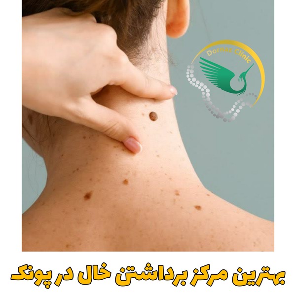 مرکز برداشتن خال در پونک
