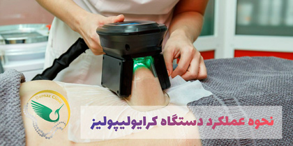 لاغری با کرایولیپولیز