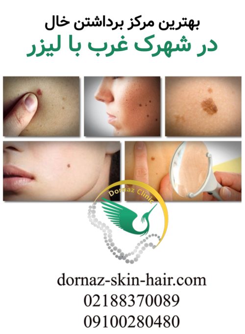 بهترین مرکز برداشتن خال