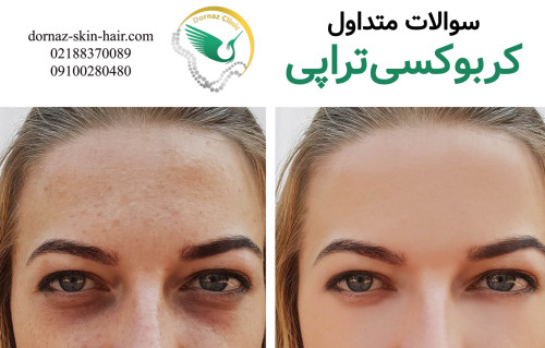 سوالات رایج کربوکسی تراپی