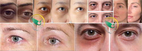 عکس قبل و بعد کربوکسی تراپی