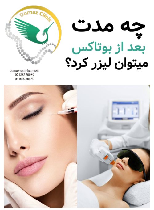 چه مدت بعد از بوتاکس میتوان لیزر کرد؟