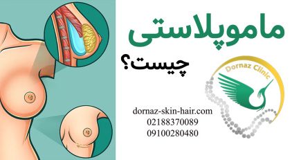 ماموپلاستی یعنی چه؟