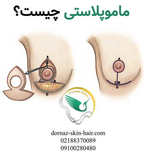 ماموپلاستی چیست؟