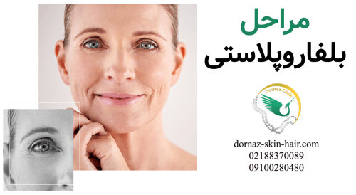 مراحل بلفاروپلاستی چیست؟ 