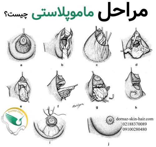مراحل ماموپلاستی چگونه است؟