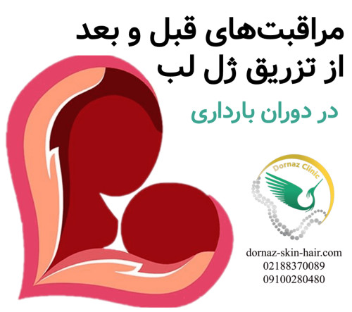 مراقبت های قبل و بعد از تزریق ژل لب