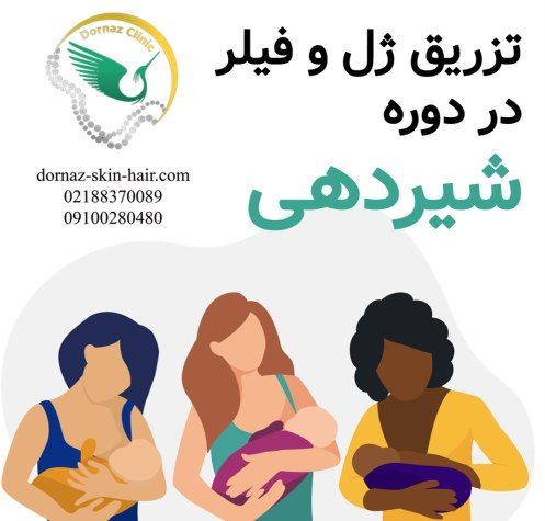 تزریق ژل و فیلر در دوره شیردهی