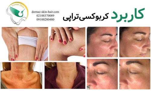 کربوکسی تراپی چکار می کند؟