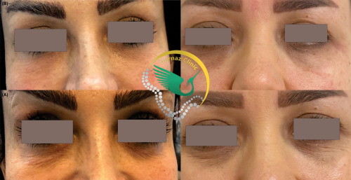 عکس قبل و بعد کربوکسی تراپی زیر چشم