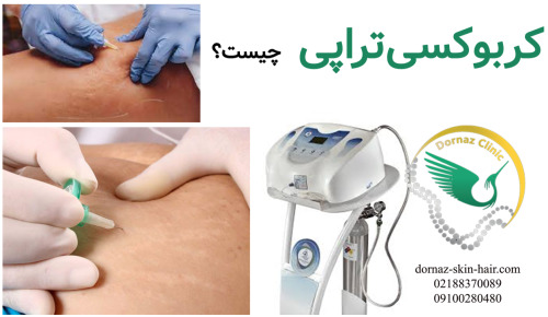 کربوکسی تراپی یعنی چه؟