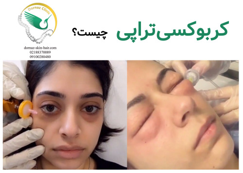 کربوکسی تراپی یعنی چه؟