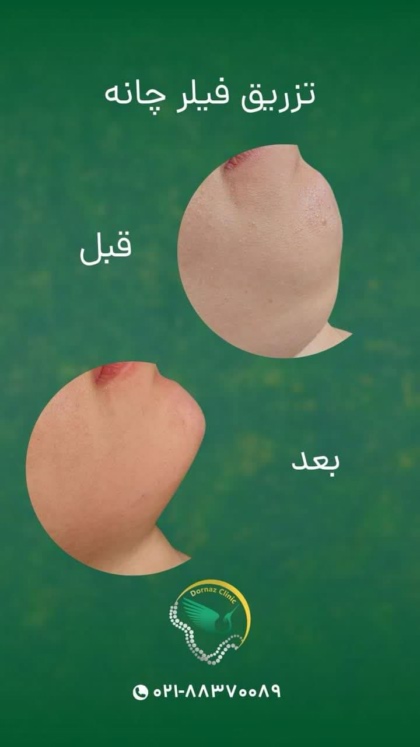 نمونه قبل و بعد فیلر چانه