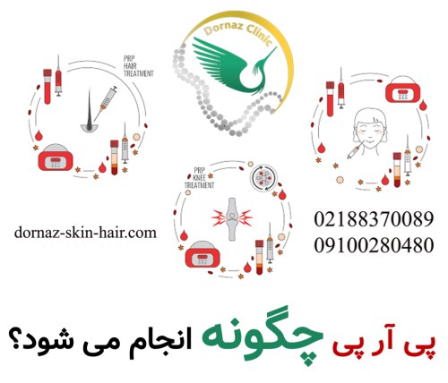 پی ار پی چگونه انجام می شود؟