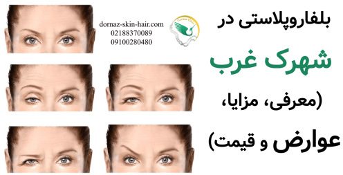بلفاروپلاستی در شهرک غرب (معرفی، مزایا، عوارض و قیمت)