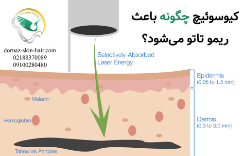 کیوسوئیچ چگونه می تواند باعث از بین رفتن تاتو شود؟