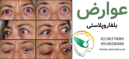 عوارض بلفاروپلاستی