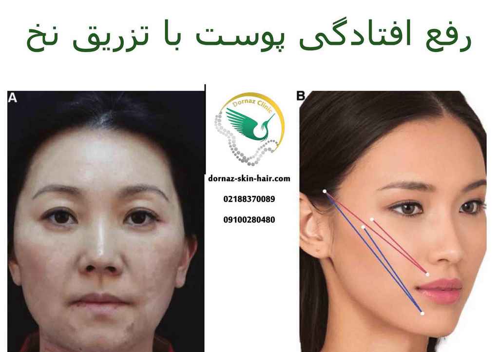 رفع افتادگی با لیفت با نخ