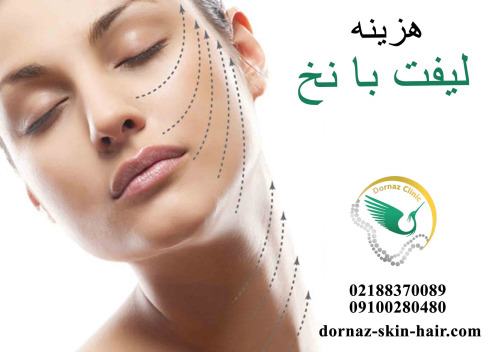 هزینه لیفت با نخ