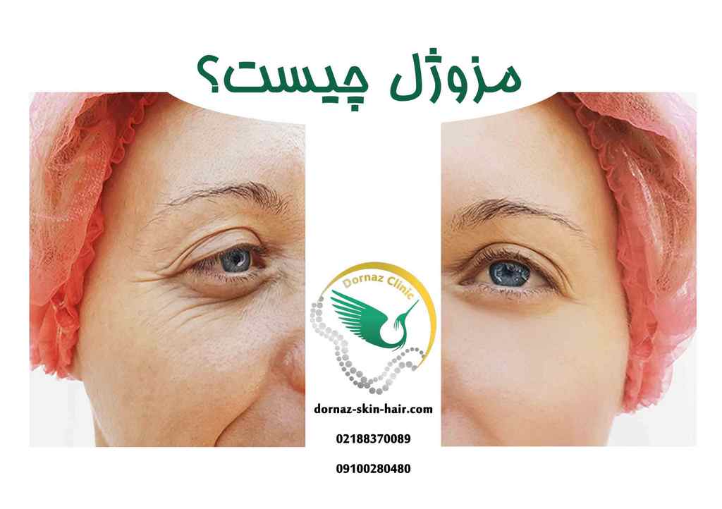 مزوژل چیست
