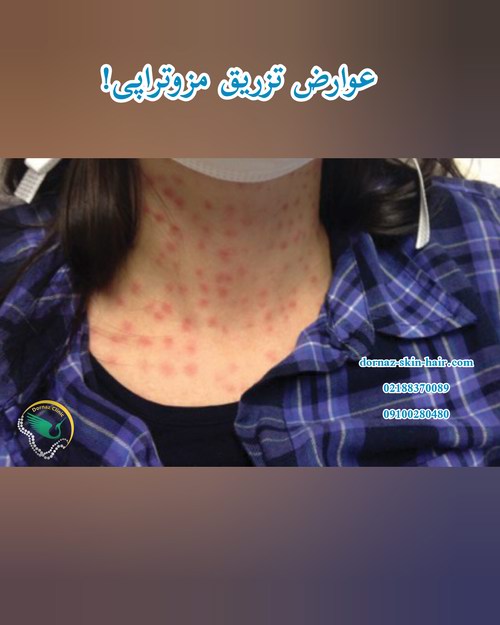عوارض تزریق مزوتراپی