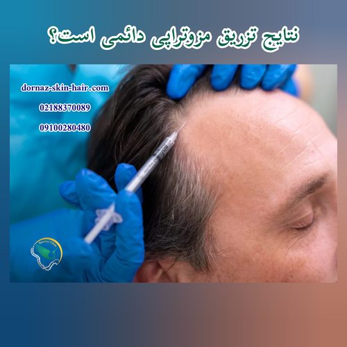 مزایای تزریق مزوتراپی در شهرک غرب دائمی است؟