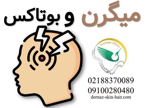 بوتاکس برای میگرن