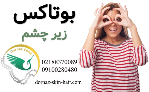 بوتاکس زیر چشم