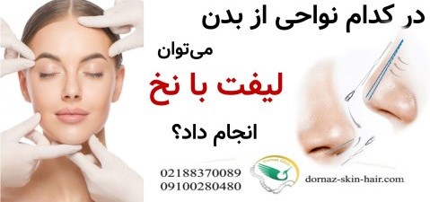 در کدام نواحی از بدن می‌توان لیفت با نخ انجام داد؟