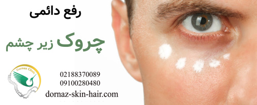 رفع دائمی چروک زیر چشملیفت با نخ اندولیفت زیر چشم کرم زیر چشم بوتاکس زیر چشم مزوتراپی زیر چشم پی آر پی زیر چشم