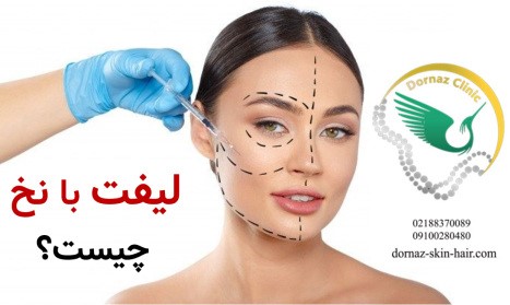 لیفت با نخ چیست؟