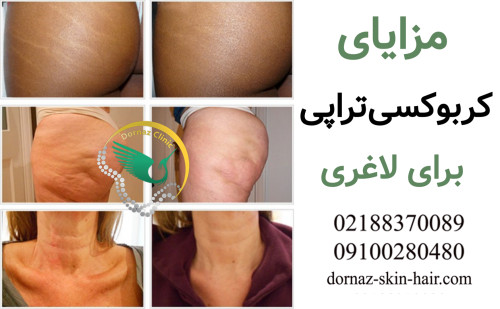 مزایا کربوکسی تراپی برای لاغری