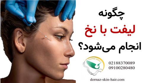 چگونه لیفت با نخ انجام می‌شود؟