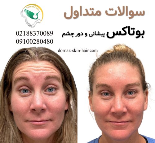سوالات متداول درباره بوتاکسمراقبت های بعد از بوتاکس بوتاکس پیشانی بوتاکس دور چشم
