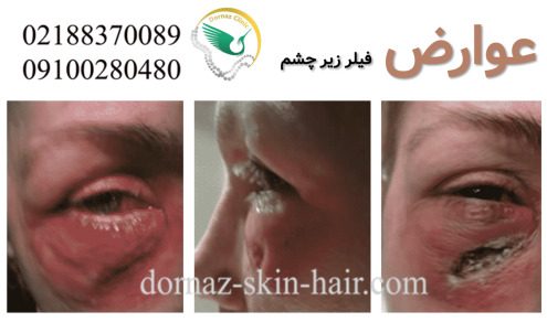 فیلر زیر چشم عوارض دارد؟