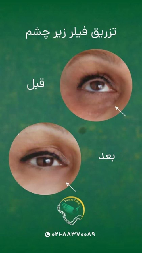 عکس قبل و بعد تزریق فیلر زیر چشم