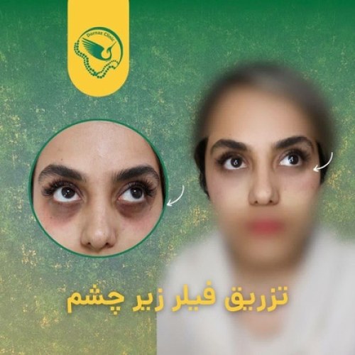 عکس فیلر زیر چشم