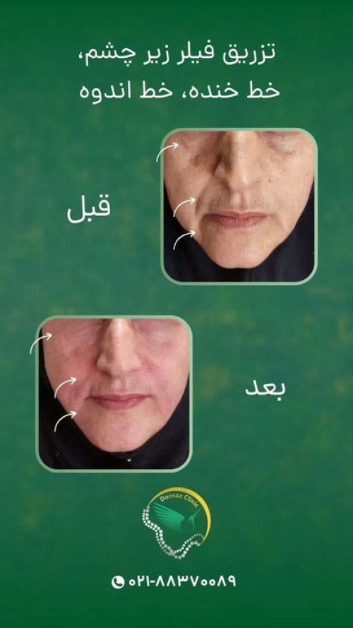 عکس قبل و بعد ژل زیر چشم