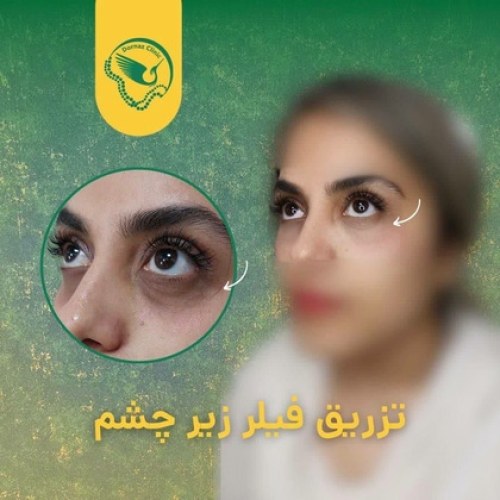 عکس قبل و بعد تزریق فیلر چشم