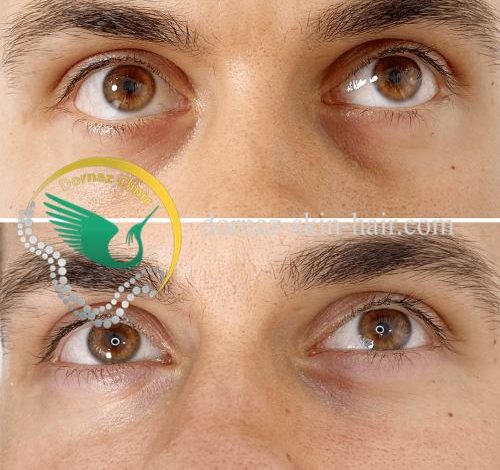 فیلر زیر چشم آقایان عکس قبل و بعد