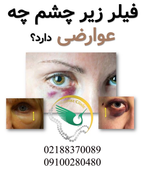 فیلر زیر چشم چه عوارضی دارد؟>عوارض فیلر زیر چشم