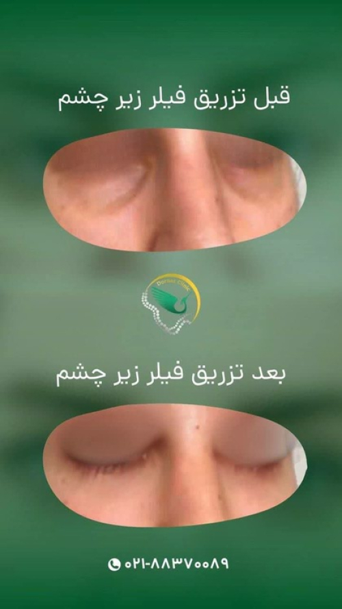 قبل و بعد فیلر زیر چشم